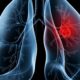 saiba-o-que-e-adenocarcinoma-pulmonar,-cancer-que-atinge-o-papa